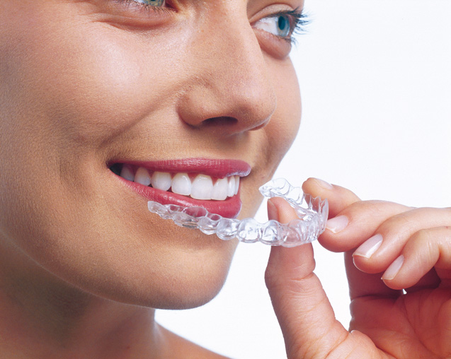 Niềng răng Invisalign là phương pháp “niềng răng” bằng những chiếc khay trong suốt gần như vô hình