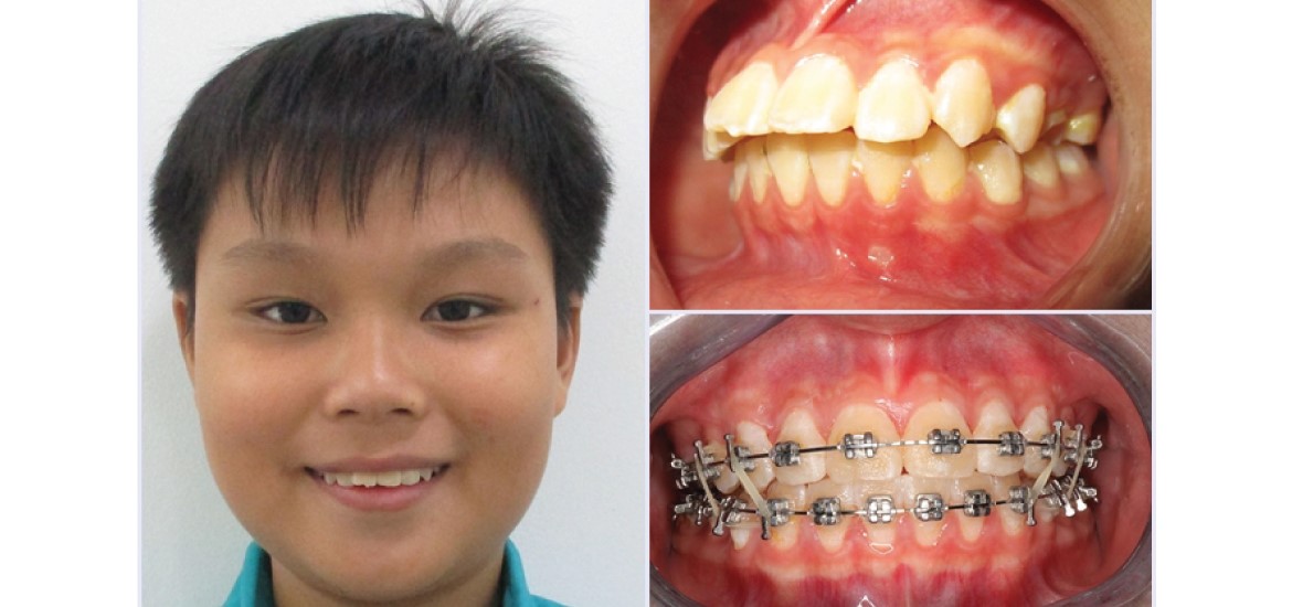 Niềng răng mắc cài kim loại được xem là nền tảng của các phương pháp niềng răng hiệu quả hiện đại. Với chất liệu hợp kim không gỉ Niken - Titanium, niềng răng mắc cài kim loại có độ bền, cứng chắc, lực tác dụng đều và ổn định.