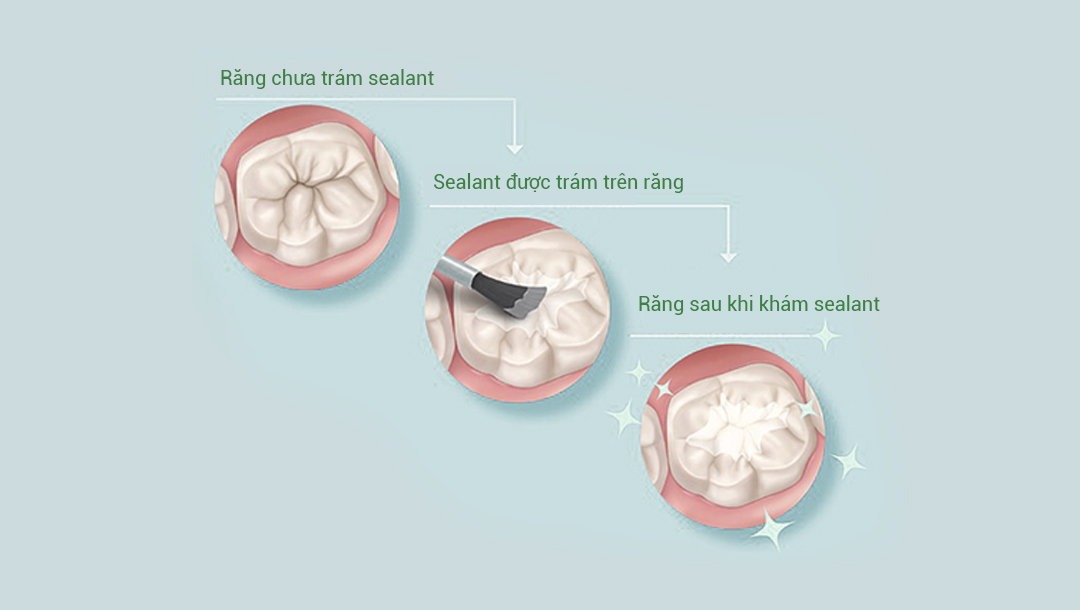 Sự khác nhau giữa trăng đã được trám Sealant